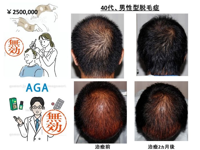 円形脱毛症　病院